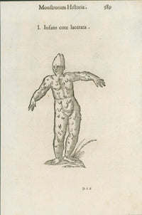 Aldrovandi — Seven Folio Leaves of Human Deformities and Monstrosities from the Monstrorum Historia, Bologna 1640 - Lumenrare Antique Prints & Maps